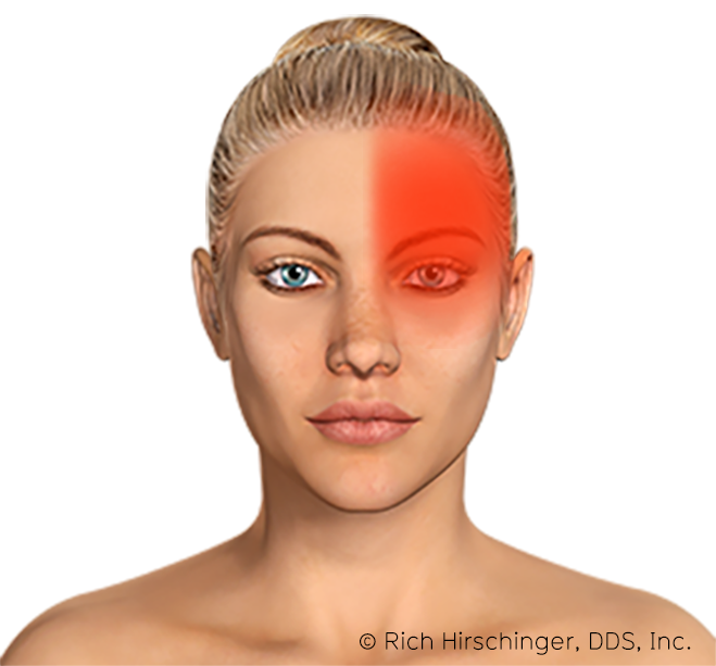 Beverly-Hills-Headache-Occipital -Neuralgia-Front.png